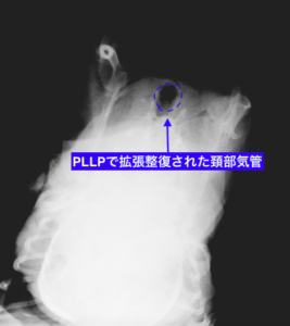 術後のPLLPにより拡張整復された頚部気管