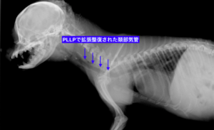 PLLP術後の拡張整復された頚部気管